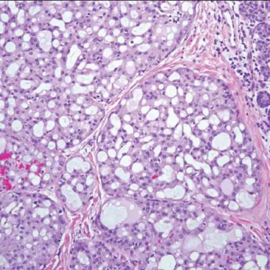 Mammary Analogous Secretory Carcinoma : Understanding a Rare Salivary Gland Tumor
